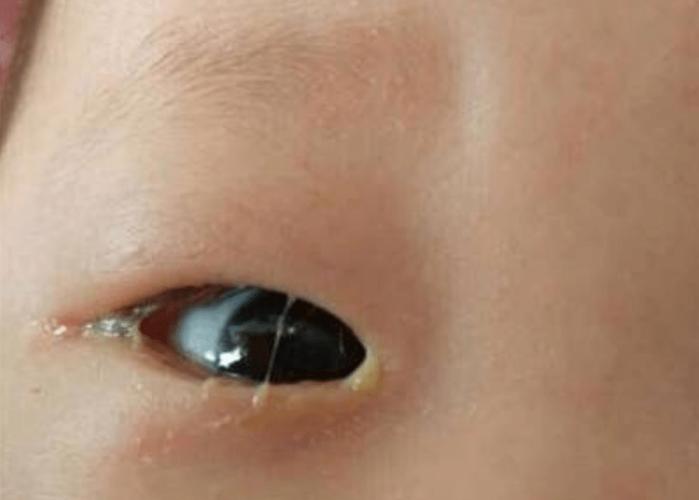 新生儿眼睛眼屎多流泪-第2张图片-郑州医学网