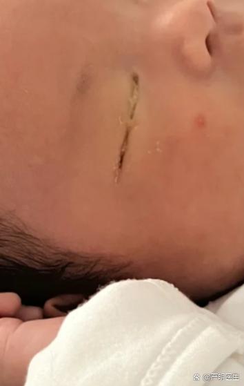 新生儿眼睛眼屎多流泪-第3张图片-郑州医学网