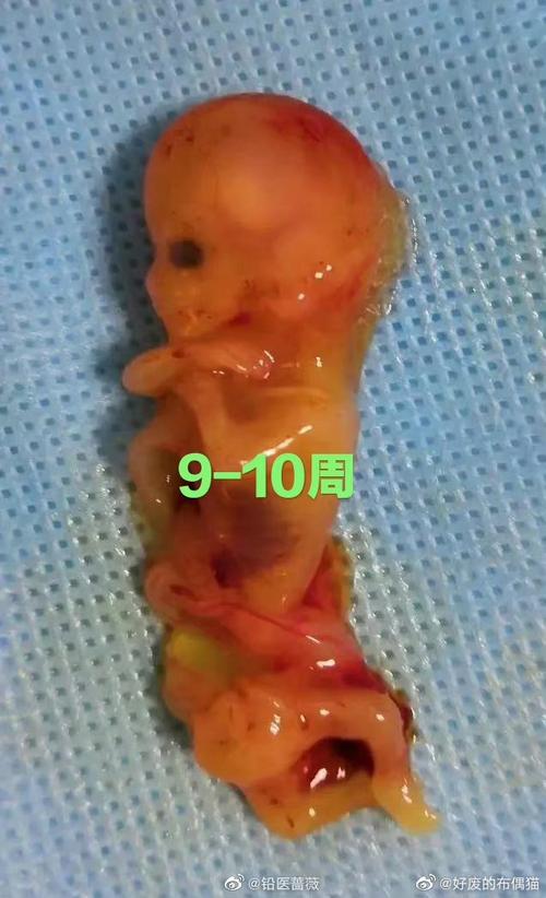 早孕期打掉孩子的身心煎熬，该如何承受与疗愈？-第3张图片-郑州医学网