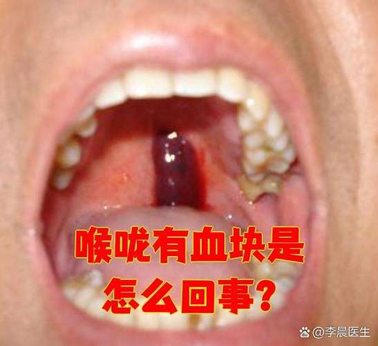 孕期喉咙出血是上火还是身体异常信号？需警惕哪些潜在风险？-第3张图片-郑州医学网