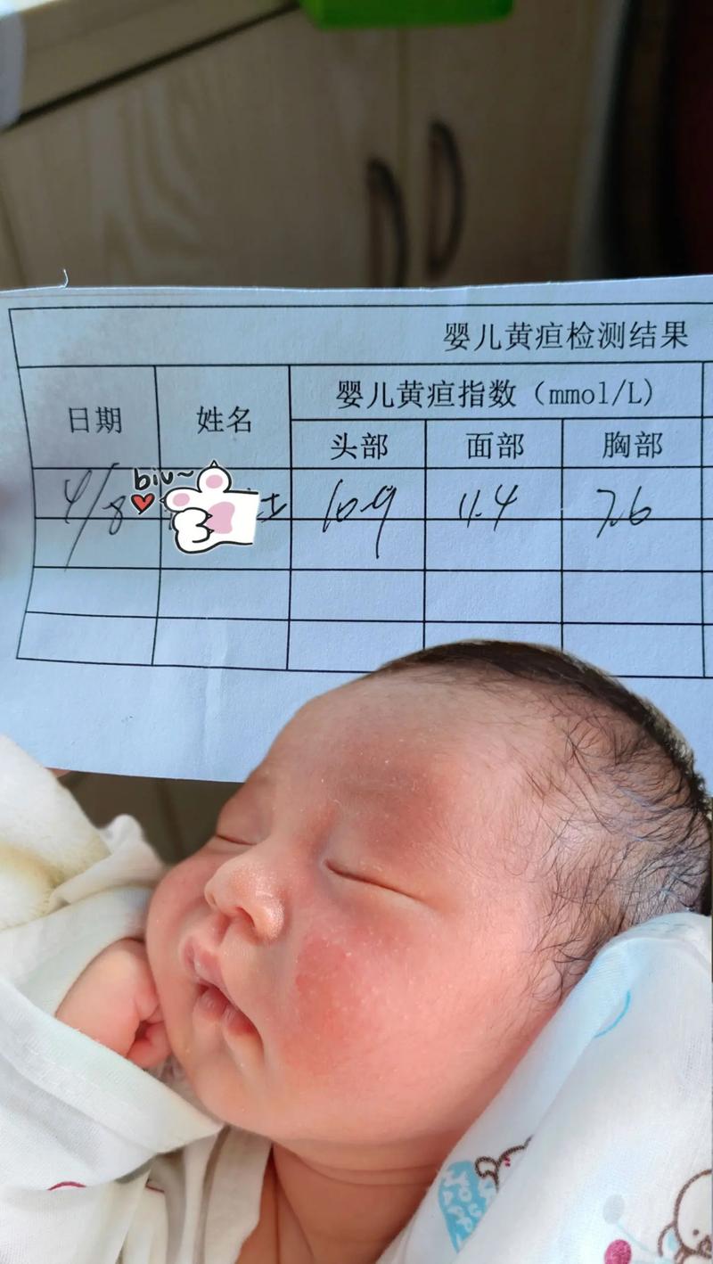 新生儿16天黄疸15-第2张图片-郑州医学网