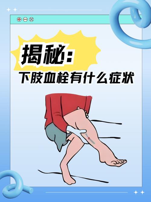 孕期血栓有什么症状吗-第3张图片-郑州医学网