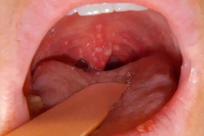 感觉新生儿喉咙有东西-第3张图片-郑州医学网