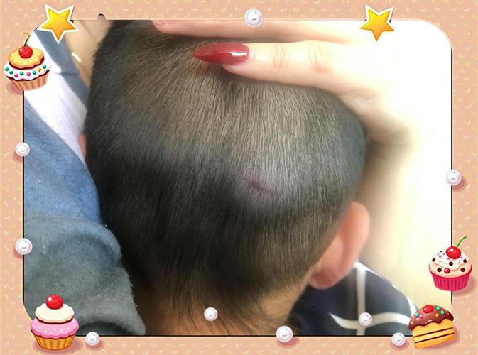 新生儿头上的血肿变硬-第2张图片-郑州医学网 新生儿头上的血肿变硬-第2张图片-郑州医学网