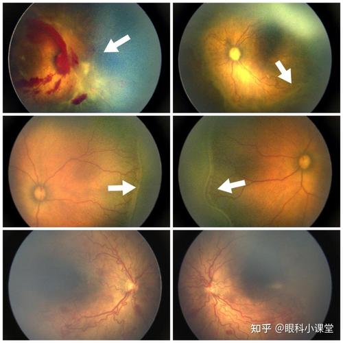 新生儿视网膜血管发育异常，究竟会对视力造成哪些潜在影响？-第2张图片-郑州医学网