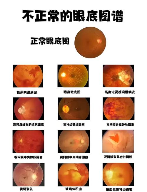 新生儿视网膜血管发育异常，究竟会对视力造成哪些潜在影响？-第3张图片-郑州医学网