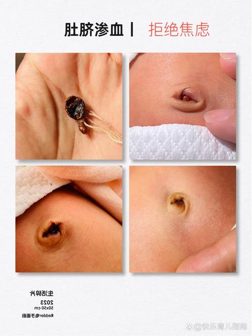新生儿肚脐流血的原因-第2张图片-郑州医学网
