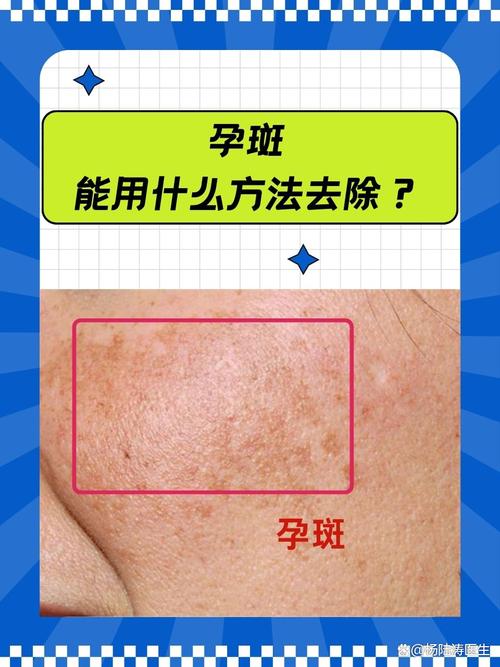 孕期脸上长斑怎么预防-第3张图片-郑州医学网