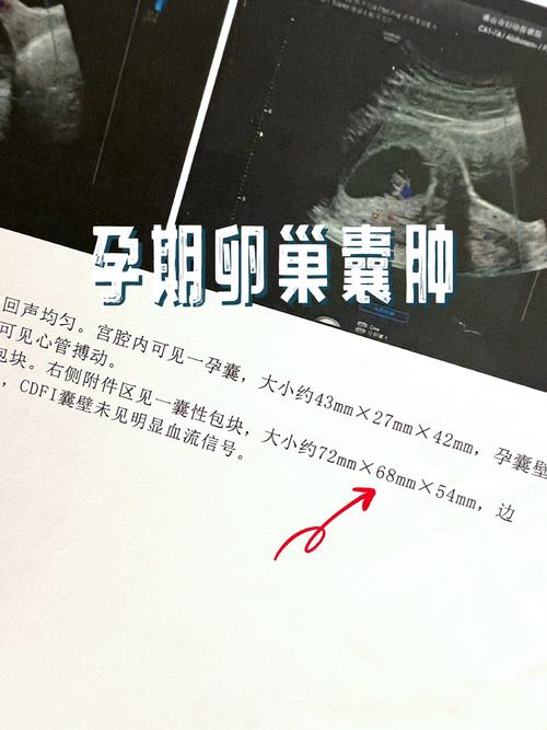孕期黄体囊肿会自行消失吗？对胎儿有影响吗？需要治疗吗？-第1张图片-郑州医学网