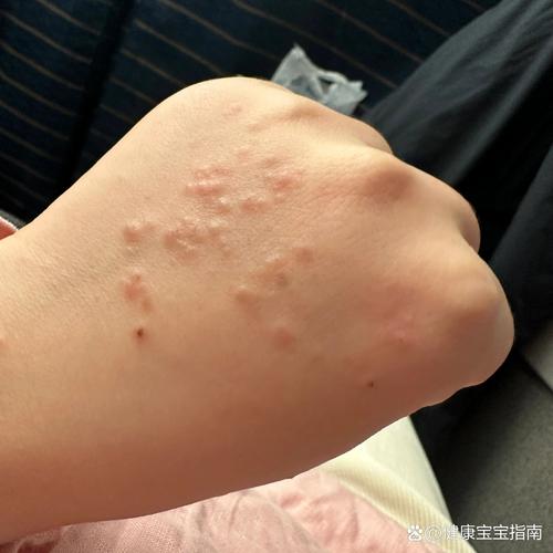 孕期有湿疹胎儿有影响-第2张图片-郑州医学网