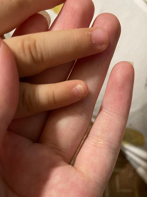 儿童手指甲起层是缺乏营养还是疾病信号？附图片详解原因及应对方法-第3张图片-郑州医学网
