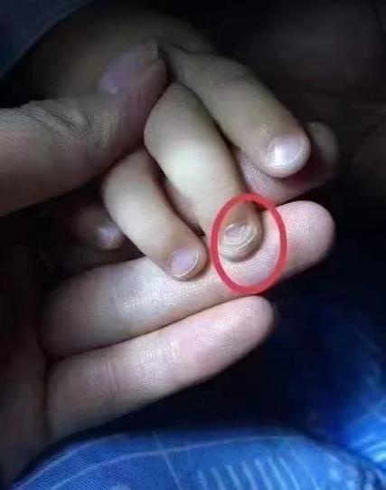 儿童手指甲起层是缺乏营养还是疾病信号？附图片详解原因及应对方法-第1张图片-郑州医学网