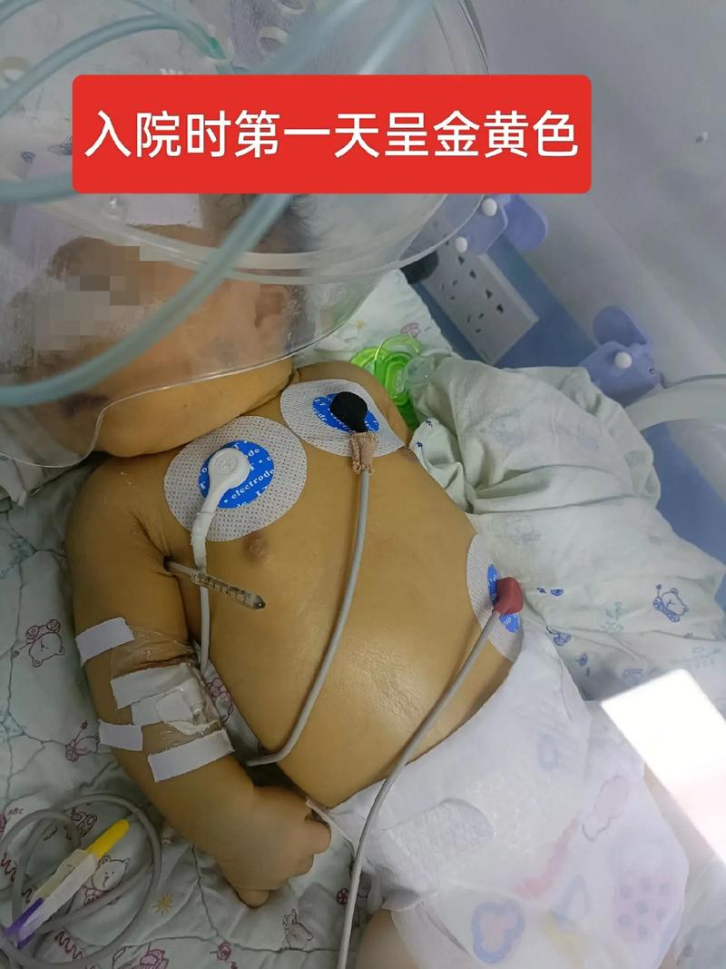 新生儿溶血性黄疸住院-第1张图片-郑州医学网
