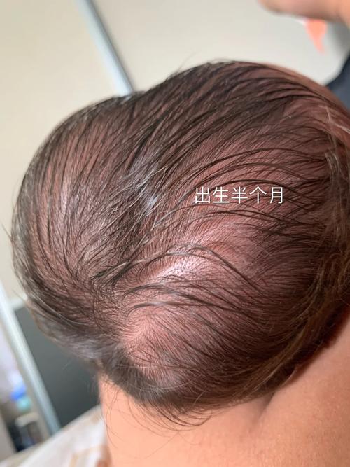 新生儿产瘤与头皮血肿如何区分？对宝宝健康有何影响？-第1张图片-郑州医学网