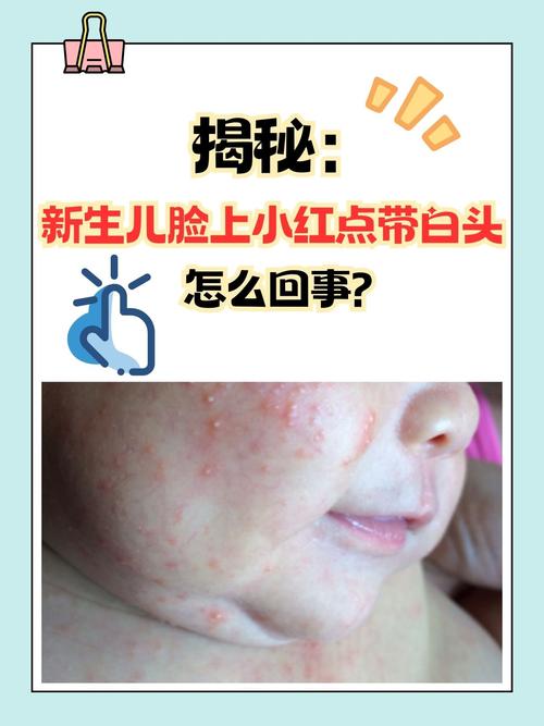 新生儿脸红是正常生理现象还是疾病信号？需关注哪些伴随症状？-第1张图片-郑州医学网