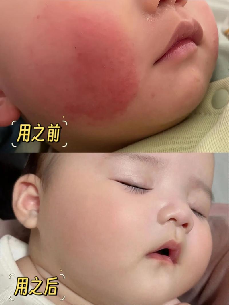 新生儿脸红是正常生理现象还是疾病信号？需关注哪些伴随症状？-第2张图片-郑州医学网