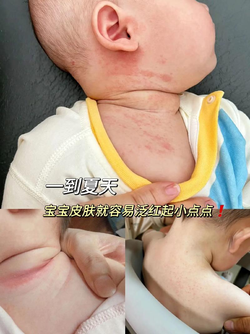 新生儿脸红是正常生理现象还是疾病信号？需关注哪些伴随症状？-第3张图片-郑州医学网