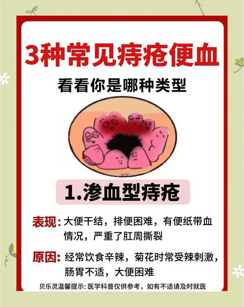 如何缓解孕期痔疮出血-第1张图片-郑州医学网