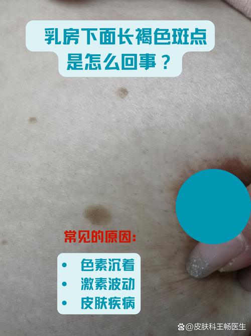 孕期乳房周围褐色斑点-第1张图片-郑州医学网