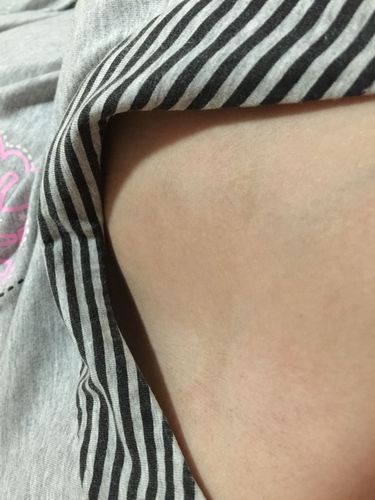 孕期乳房周围褐色斑点-第3张图片-郑州医学网