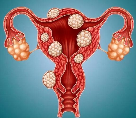孕期遭遇子宫肌瘤红色变性，该如何应对才能保障母婴安全？-第2张图片-郑州医学网