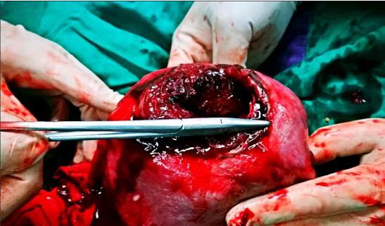 孕期遭遇子宫肌瘤红色变性，该如何应对才能保障母婴安全？-第3张图片-郑州医学网