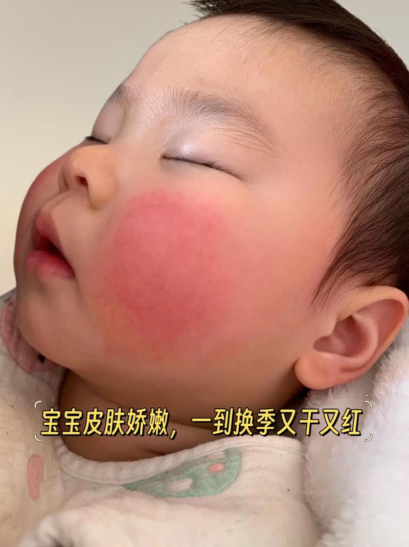 新生儿脸老是涨的通红-第1张图片-郑州医学网 新生儿脸老是涨的通红-第1张图片-郑州医学网
