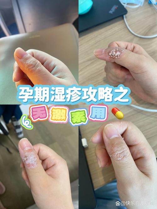 孕期湿疹会对胎儿造成哪些潜在影响？需要担心吗？-第1张图片-郑州医学网