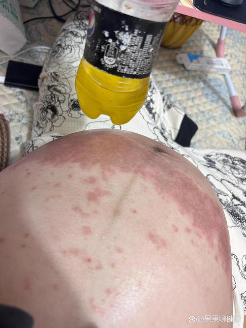孕期湿疹会对胎儿造成哪些潜在影响？需要担心吗？-第2张图片-郑州医学网