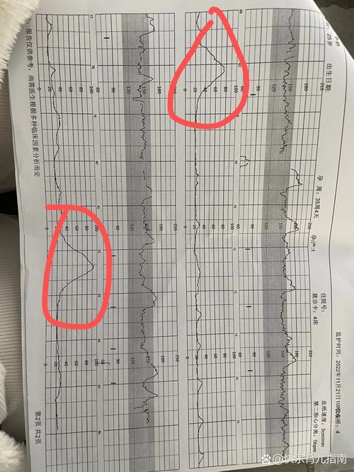 孕期检查nst是什么-第3张图片-郑州医学网