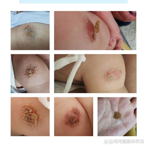 新生儿 手臂 卡介苗-第2张图片-郑州医学网