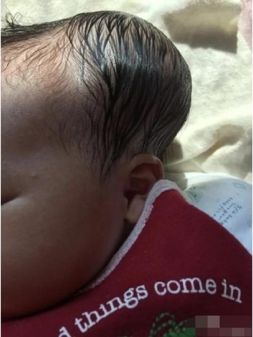 新生儿血肿 颅内出血-第2张图片-郑州医学网