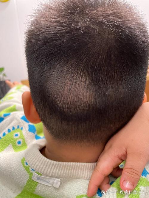 新生儿血肿 颅内出血-第3张图片-郑州医学网