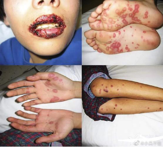 儿童败血症的症状表现-第2张图片-郑州医学网