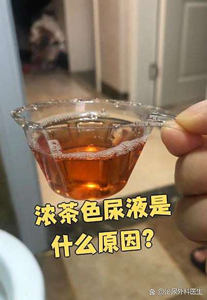 儿童尿是茶色怎么回事-第3张图片-郑州医学网