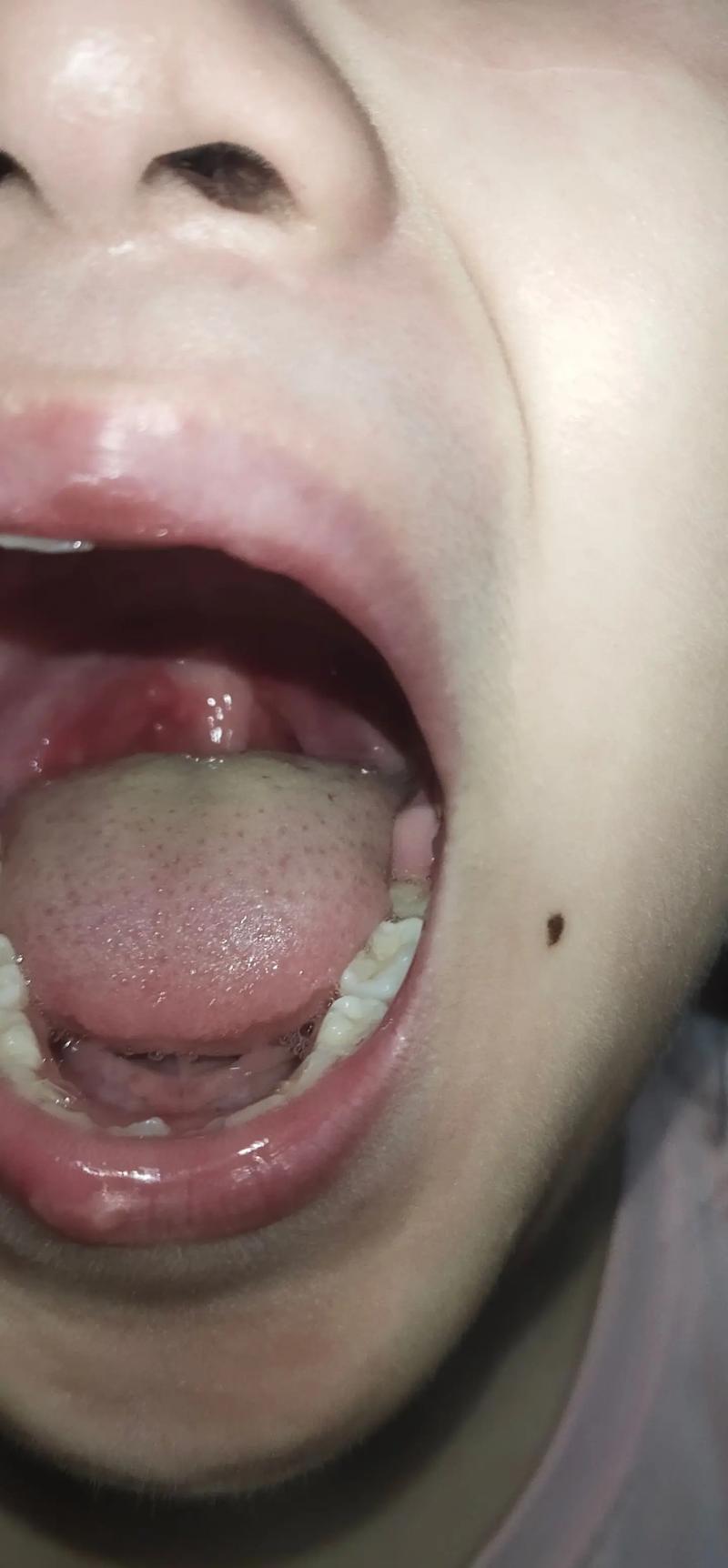 儿童嗓子起小泡是手足口病吗？需要怎么处理？-第2张图片-郑州医学网