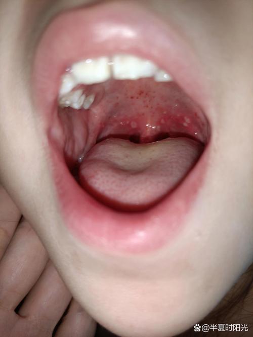 儿童嗓子起小泡是手足口病吗？需要怎么处理？-第1张图片-郑州医学网