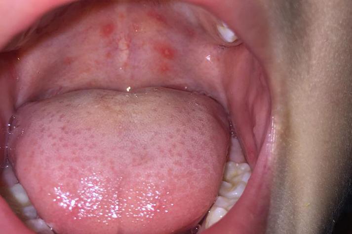 儿童嗓子起小泡是手足口病吗？需要怎么处理？-第3张图片-郑州医学网