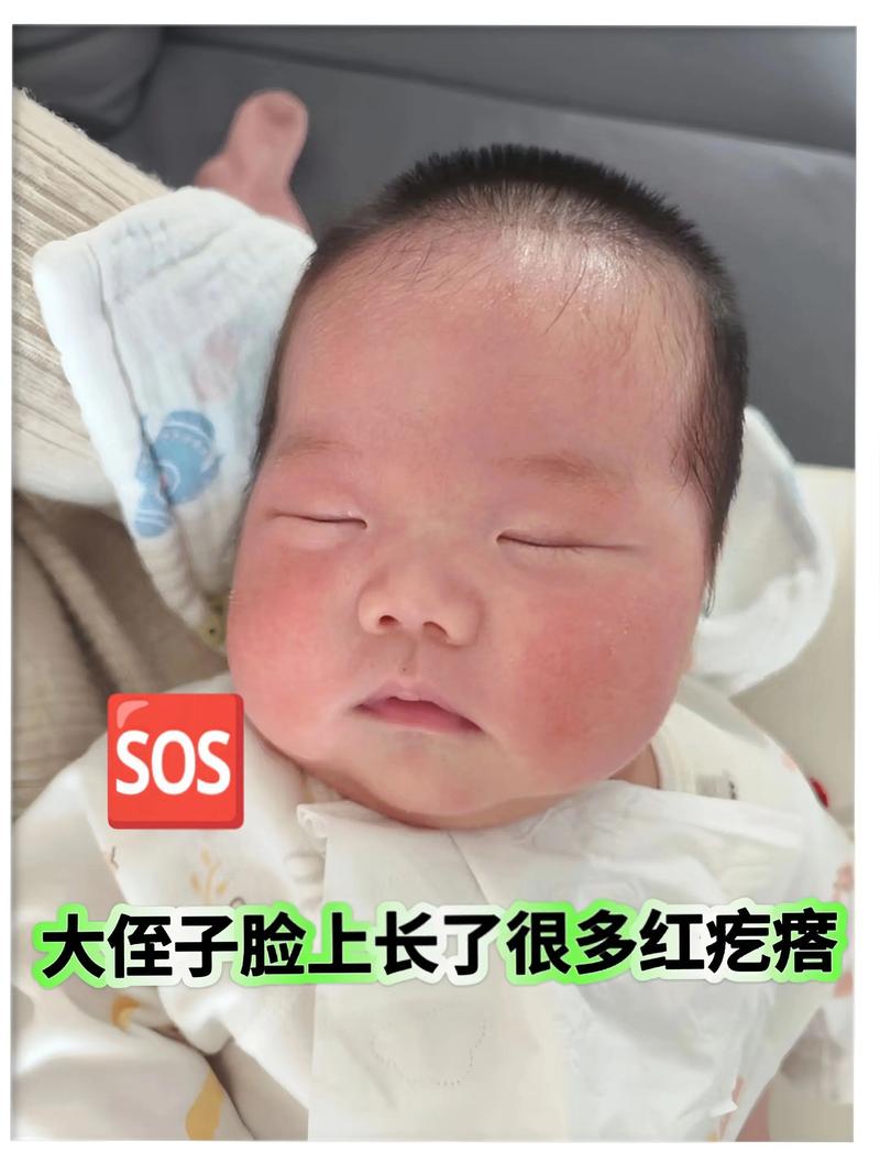 新生儿 脸上小红疙瘩-第1张图片-郑州医学网
