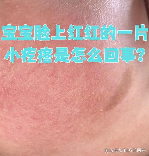 新生儿 脸上小红疙瘩-第2张图片-郑州医学网