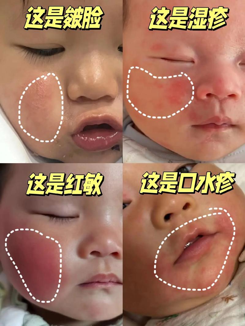 儿童脸上鸡皮肤怎么办-第3张图片-郑州医学网