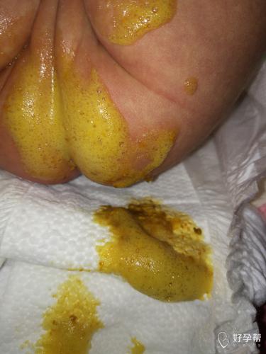 新生儿拉沫是怎么回事-第3张图片-郑州医学网