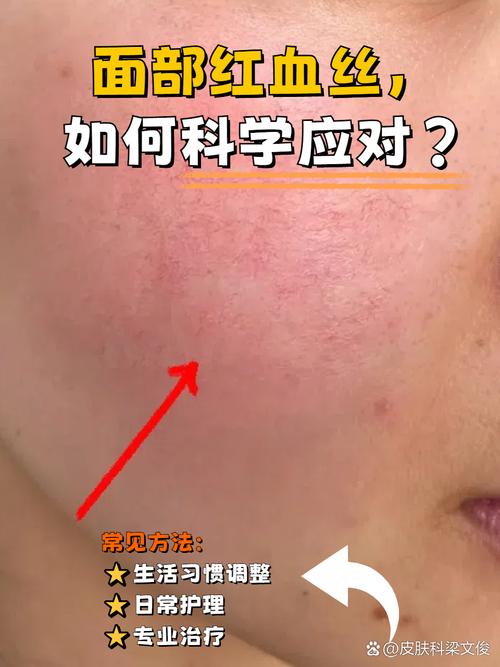 怀孕期间脸上有红血丝-第2张图片-郑州医学网