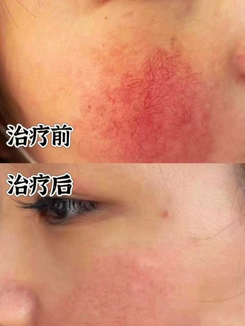 怀孕期间脸上有红血丝-第3张图片-郑州医学网