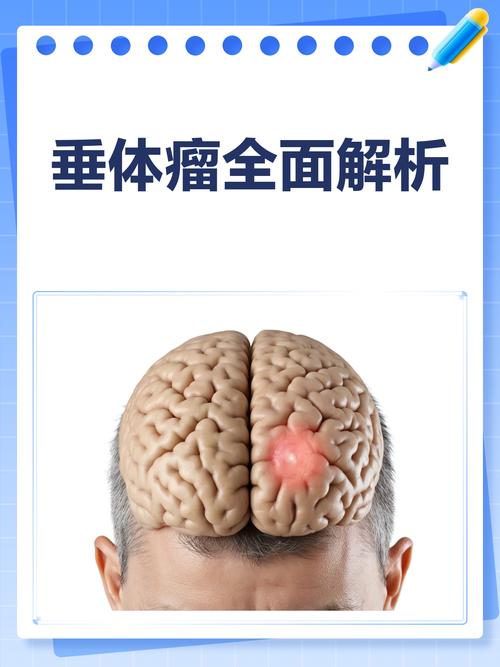 儿童脑部垂体瘤严重吗？早发现早治疗能控制病情吗？-第3张图片-郑州医学网