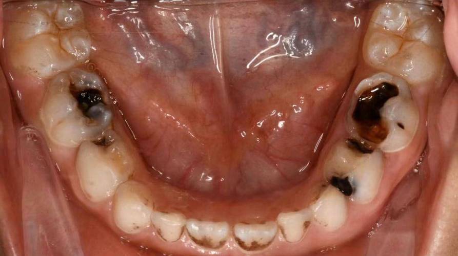 6岁儿童牙齿发黑有洞-第1张图片-郑州医学网