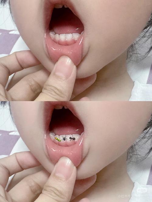 6岁儿童牙齿发黑有洞-第2张图片-郑州医学网