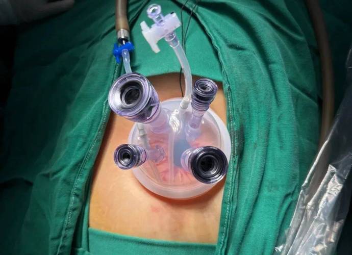 孕期腹腔镜微创手术安全吗?对胎儿发育有影响吗?-第3张图片-郑州医学网 孕期腹腔镜微创手术安全吗?对胎儿发育有影响吗?-第3张图片-郑州医学网