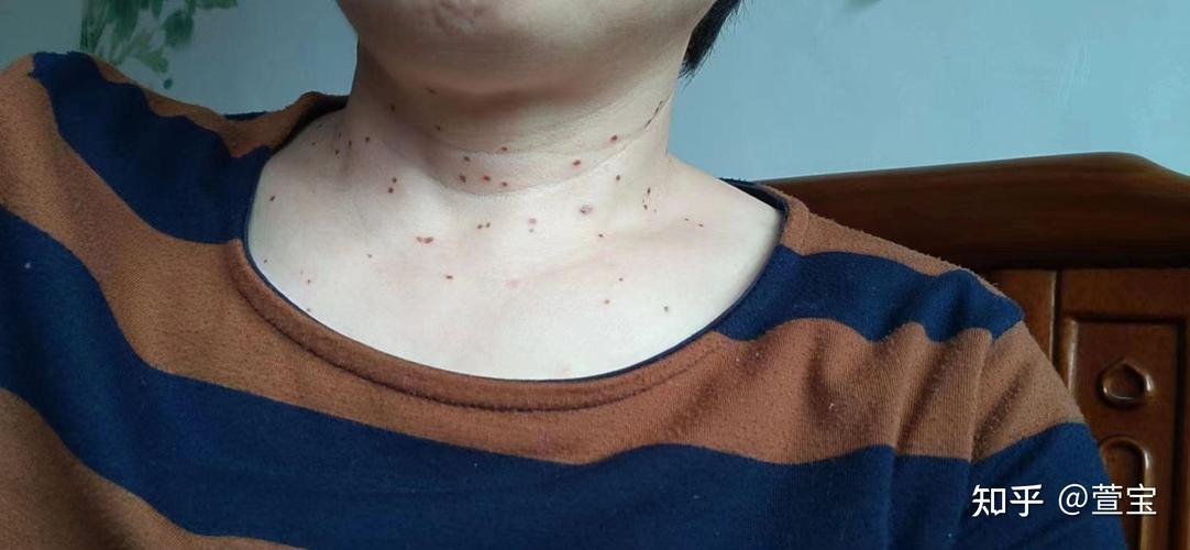 怀孕期间脖子上长肉揪是孕期正常现象吗？需要担心什么问题？-第2张图片-郑州医学网