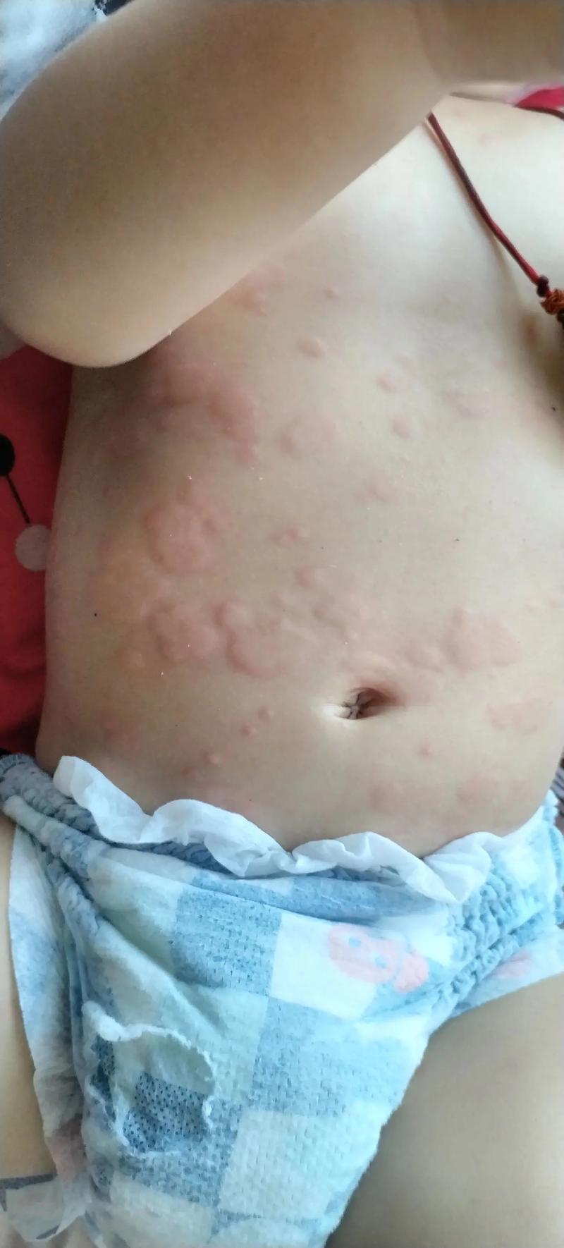 儿童身上长红疹是芥疮吗？症状和图片如何辨别？-第1张图片-郑州医学网